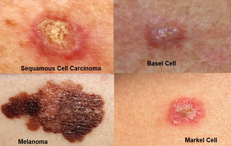 Skin Cancer Types and Symptoms