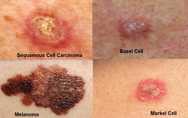 types of skin cancer        <h3 class=