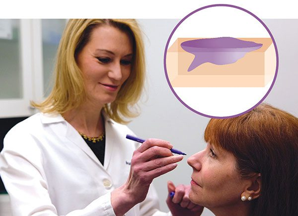 The Most Effective Technique for Treating Common Skin Cancers
