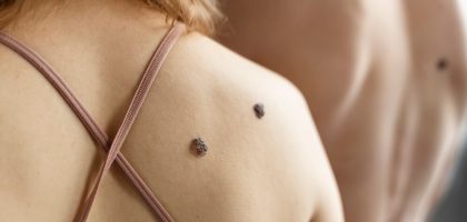Skin Cancer Mole Signs and Symptoms