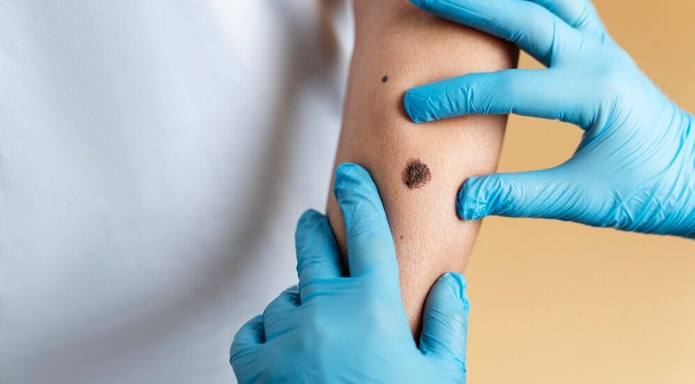 Early Detection of Skin Cancer
