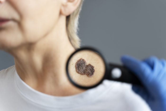 Understanding the Importance of Skin Cancer Checks: A Comprehensive Guide